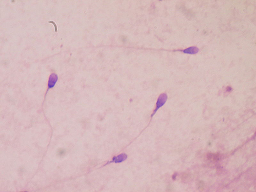 Stained sperm sample captured in a clinical laboratory under the microscope.