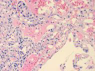 lung image