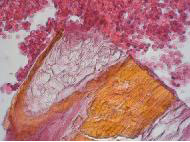 Pathology appendix image