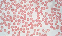 Erthrocytes (blood cells) captured under a hematology microscope.