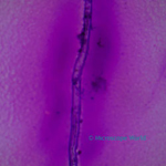 Tuberculosis under microscope